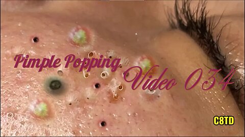 Satisfying Pimple Popping Videos 034