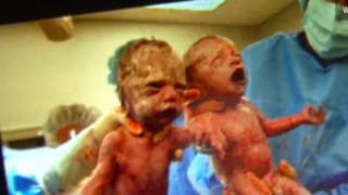 Twins With Rare Condition Born Holding Hands