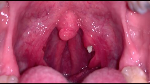 Removal of a tonsil stone