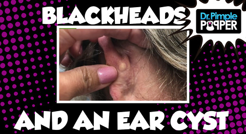 Back Blackheads and an Ear Cyst