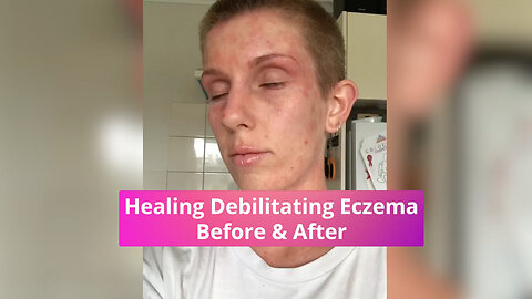 Healed Debilitating Eczema Before & After - Repost from @bex_stone_94