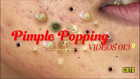 Satisfying Pimple Popping Videos 013