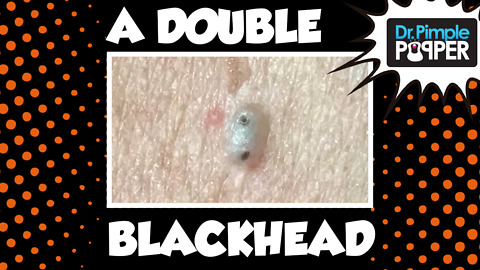 Blackhead? Make it a DOUBLE!