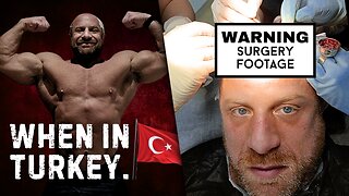 Hair Transplant In Turkey | My Experience