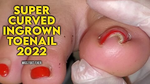 2022 Super curved ingrown toenail removal by foot specialist miss foot fixer