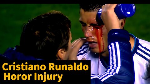 Cristiano Runaldo Injured 😲😱😱 | Eye Bleeding 🩸🩸 #shorts