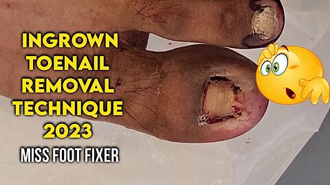 [left Nail ]Effective Ingrown Toenail Removal Techniques: Goodbye to Painful Nails! Miss foot fixer