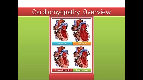 Cardiomyopathy - Comprehensive Overview