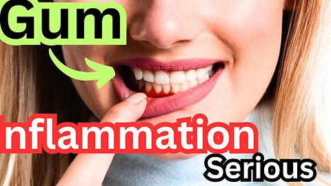 ✅Gum Inflammation Serious - Cure Gum Disease Without a Dentist🚨