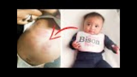 Mom Picks 6 month old Baby Daughter Up at Daycare to Discover Her Whole Body is Covered in Bites