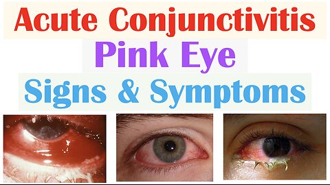 Conjunctivitis Signs & Symptoms (Allergic, Bacterial and Viral) & Why Symptoms Occur