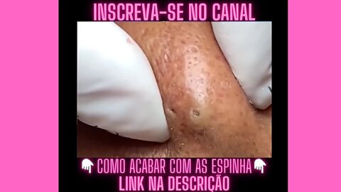 Cravo gigante nas costas Espremendo Espinhas e Cravos