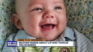 Spreading awareness about lip and tongue ties in babies