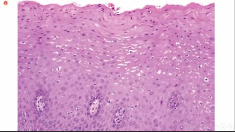 Oral pathology L13 (keratosis and related disorders of oral mucosa)