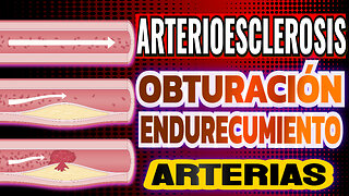 ARTERIOESCLEROSIS. Endurecimiento de ARTERIAS. Escucha Frecuencias de RIFE.