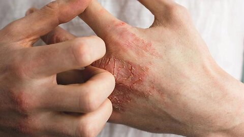 How to Treat Eczema