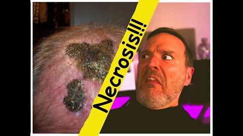 Hair Transplant Necrosis - DEAD SCALP After Surgery!