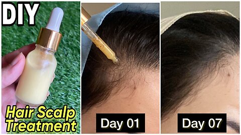 7 Days Challenge - DIY SCALP TREATMENT FOR HAIR THINNIG & EXTREME HAIR LOSS -Hairline regrowth serum