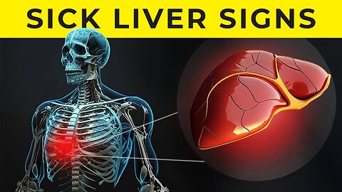 9 MAJOR Signs Of Liver Disease | What To Look For!