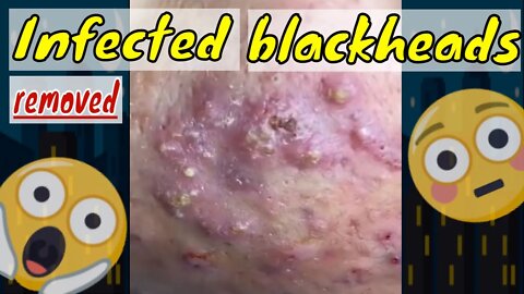 Infected blackheads on face get removed 😱 #blackheadremoval #blackhead #blackheads #infectedskin