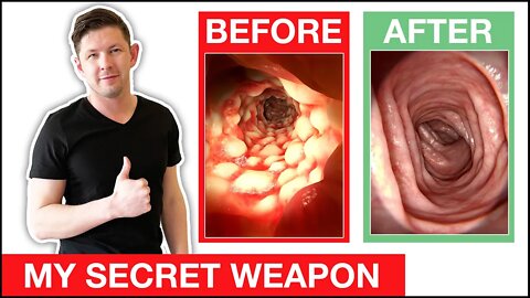 ✅ How To KILL CANDIDA in 30-DAYS with INSANELY EASY TRICK nobody knows about!!!