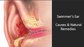 Swimmers Ear - Natural Treatment