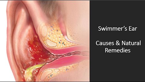 Swimmers Ear - Natural Treatment