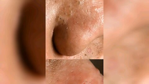 Best Satisfying Pimplepopping Tiktok Compilation