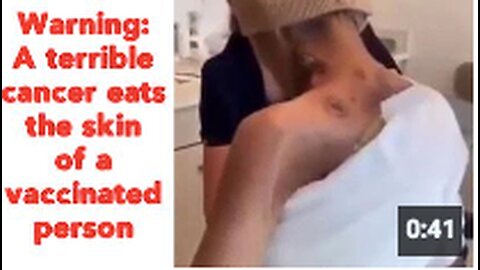 Warning: A terrible cancer eats the skin of a vaccinated person