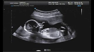 11. Ultrasound - anatomy and late pregnancy