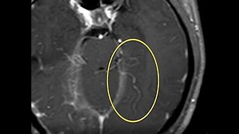 Found living worm in woman's brain-Australia doctors make shocking discovery,