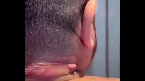 Best technique blackhead Explosion 😂