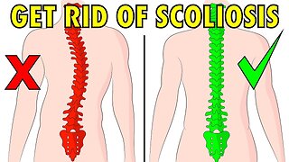 HOW TO FIX SCOLIOSIS NATURALLY IN 4 MINUTES A DAY