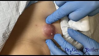 Drainage of an infected cyst on the chest