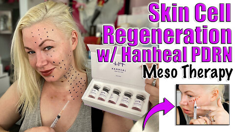 Skin Cell Regeneration w/ Hanheal PDRN Meso Therapy from www.acecosm.com | Code Jessica10 Saves $$$