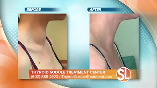 Thyroid Nodule Treatment Center: Nonsurgical treatment for thyroid nodules