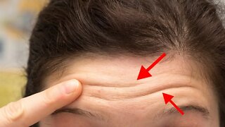 What Forehead Wrinkles Might Tell You About Your Heart Health