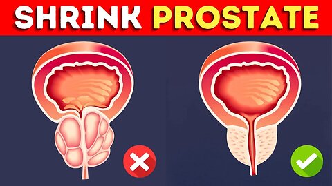 How to Shrink an Enlarged Prostate Fast and Naturally
