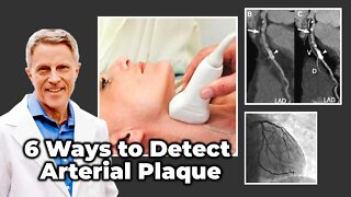 6 Ways to Detect Arterial Plaque