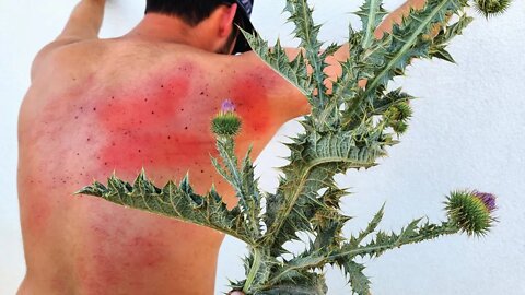 The WORST Thistle injury on the internet.