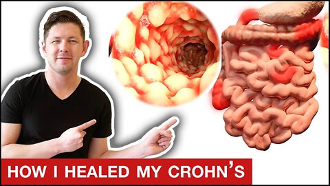 How To Heal Crohn's Disease With German New Medicine