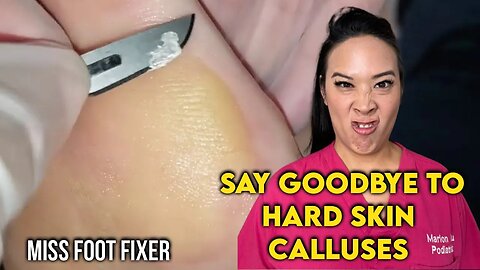 Say Goodbye to Hard Skin Calluses: Effective Treatment and Prevention By Foot Doctor Miss Foot Fixer