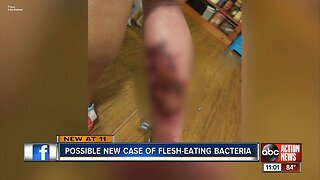 Another case of flesh-eating bacteria in Sarasota County?
