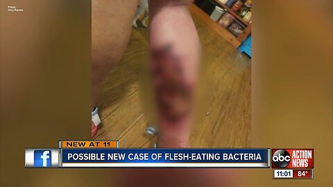 Another case of flesh-eating bacteria in Sarasota County?