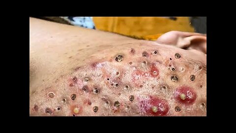 Blackheads Removal & Pimple Popper Cystic Acne Extraction Whiteheads Pimple Popping videos 111