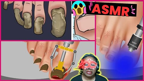 ASMR Animetion Foot Deep Cleaning Treatment | ASMR Wart Removal Treatment Animation
