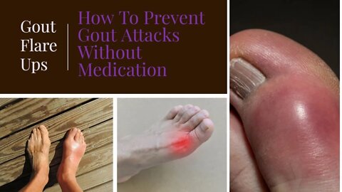 How To Prevent Gout Attacks Without Medication | Gout Flare Ups