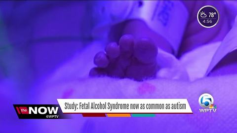 Study: Fetal Alcohol Syndrome now as common as autism