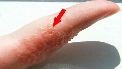 Se Você Ver Estas Bolinhas Nas Mãos e Nos Pés, Você Pode ter Esta Condição de Pele