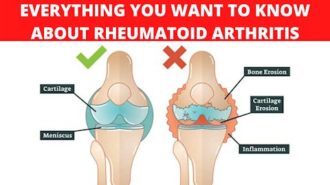 Rheumatoid Arthritis - Everything You Want To Know About Rheumatoid Arthritis